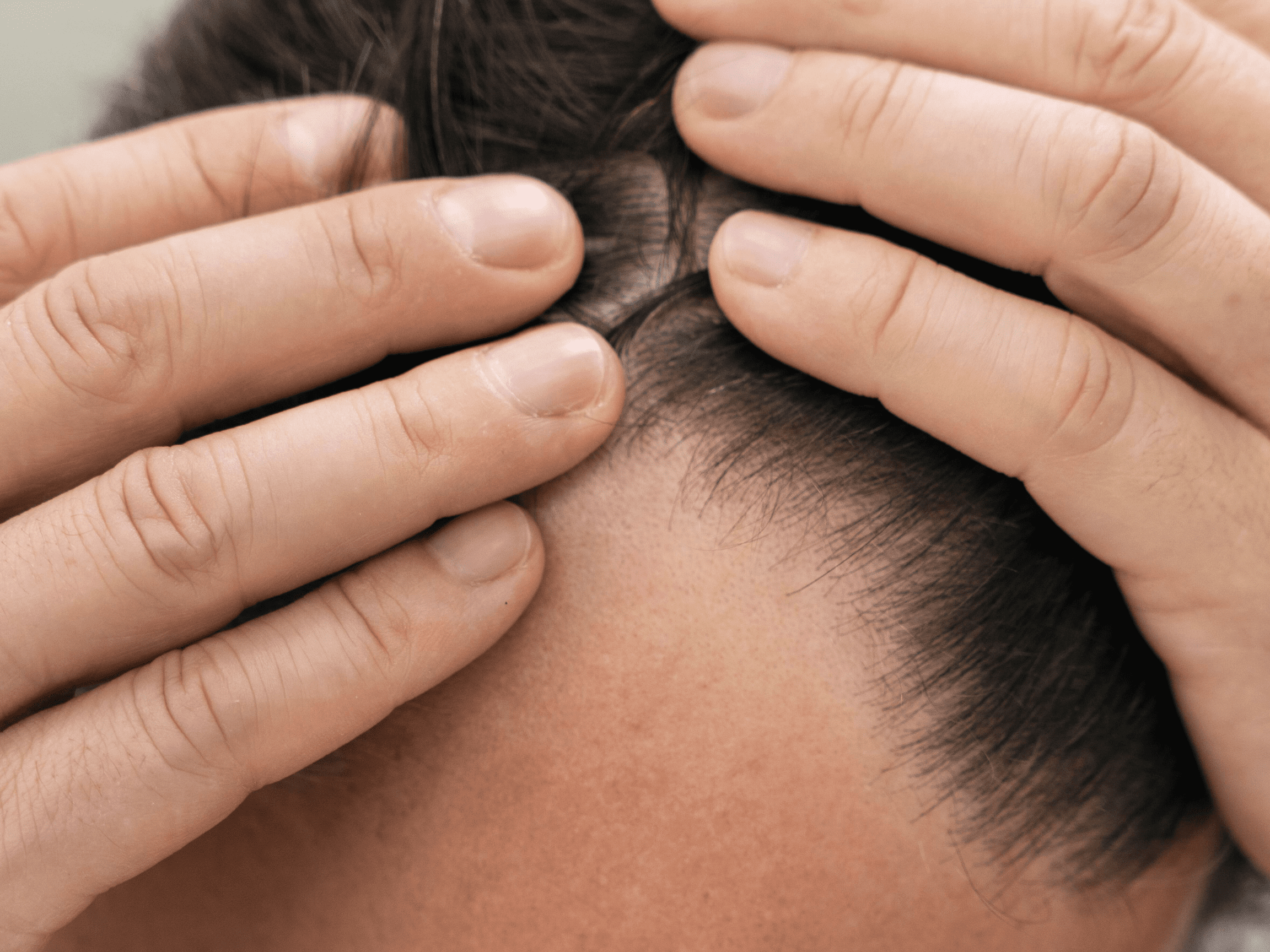 Treatment of Alopecia Areata